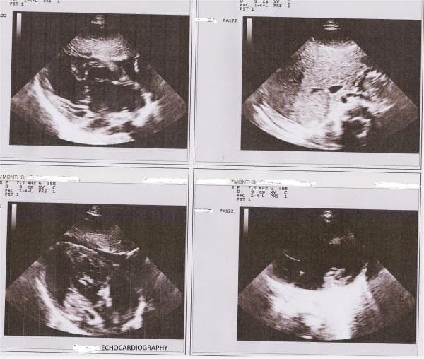 This diagnostic image displays a composite of four transthoracic echocardiography (TTE) frames obtained from a pediatric patient, utilized to evaluate complex congenital heart disease. The images are captured at a depth of 9 cm using a 7.5 MHz high-frequency transducer, appropriate for infant or small child imaging. Visually, the echocardiogram demonstrates a dextrocardia orientation with the heart situated in the right hemithorax. Key anatomical findings include significant chamber enlargement, specifically a dilated right ventricle and right atrium. The interventricular and interatrial septa show discontinuities consistent with a large perimembranous ventricular septal defect (VSD) and an ostium primum atrial septal defect (ASD). The parallel orientation of the great arteries suggests a Transposition of the Great Arteries (TGA). These views highlight the structural complexity associated with heterotaxy syndromes or situs inversus, illustrating the relationship between atrial and ventricular septal defects and conotruncal abnormalities in a single clinical case.