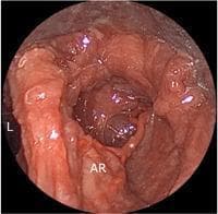 This endoscopic clinical photograph displays the internal anatomy of a human larynx, focusing on the right arytenoid region. The laryngeal lumen (L) is visible as a dark central cavity. The right arytenoid area (AR) is located at the lower portion of the frame, showing characteristic reddish, mucosal tissue. An anatomical variation is highlighted with an asterisk (*), demonstrating an ascending branch of the right superior laryngeal artery (SLA). Unlike the more common descending course, this specific arterial branch exhibits an upward trajectory from the arytenoid region toward the supraglottic space. The image serves as a cadaveric reference for laryngeal microvascular anatomy and surgical planning, illustrating the variability of blood supply to the posterior larynx and intrinsic muscles. This material is relevant for advanced otorhinolaryngology students and surgeons studying laryngeal neurovascular pathways and potential variations encountered during endoscopic or surgical procedures.