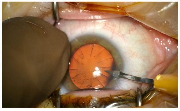 This intraoperative clinical photograph captures the anterior segment of a human eye during a cataract surgery following a historical radial keratotomy (RK). The cornea demonstrates multiple distinct radial incisions, approximately 12 to 16 in number, which extend from the central pupillary zone toward the limbus, a hallmark of prior refractive surgery for myopia. These scars appear as linear, fibrotic tracks on the corneal surface. A surgical micro-blade with a yellow handle is visible on the right, performing a lateral clear corneal incision between two existing RK scars. On the left, a blunt stabilizer or surgical gloved finger provides globe immobilization. Speculums are in place to retract the eyelids, exposing the bulbar conjunctiva, which shows mild surgical hyperemia. The red reflex is visible through the pupil, highlighting the radial arrangement of the old incisions. This image illustrates the surgical challenge of creating new cataract incisions while avoiding intersection with unstable previous RK scars to prevent corneal dehiscence or irregular astigmatism.