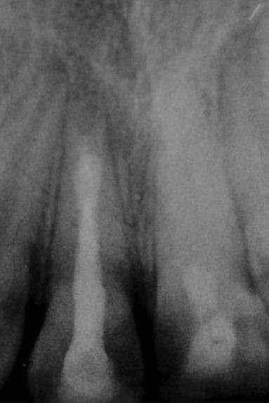 This periapical radiograph displays the maxillary central incisors (teeth 11 and 21) following endodontic treatment. Tooth 11 shows a successful apexification with a distinct apical barrier. The root canal is obturated with materials of varying radiopacity: a dense Mineral Trioxide Aggregate (MTA) plug at the apical third and a slightly less dense gutta-percha filling in the coronal two-thirds. Tooth 21 demonstrates near-complete pulp canal obliteration (calcific metamorphosis) with a visible extension of the root length, characteristic of successful pulp revascularization in an immature tooth. The surrounding periapical bone appears healthy with no signs of radiolucent inflammatory lesions. This image is an educational example of managing immature permanent teeth with open apices using different endodontic protocols: apexification for tooth 11 and regenerative endodontics/revascularization for tooth 21.