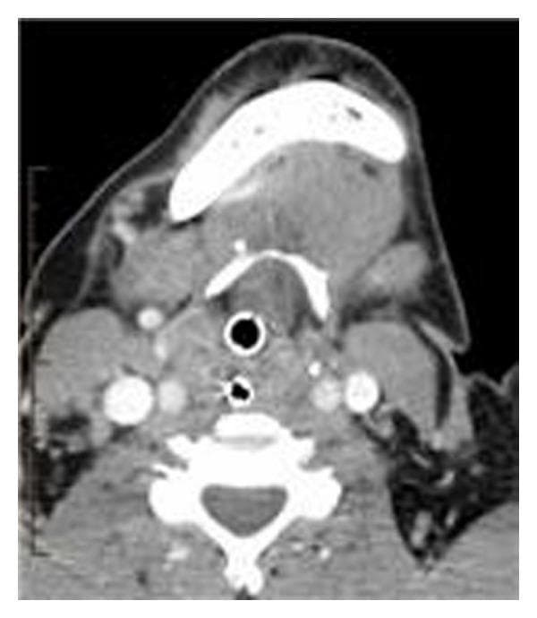 This diagnostic image is an axial computed tomography (CT) scan of the neck at the level of the oropharynx and mandible. The primary finding is a large, bulky soft tissue mass centered at the base of the tongue, which demonstrates heterogeneous density. This mass causes significant posterior displacement of tissues, resulting in near-complete obstruction of the oropharyngeal airway. An endotracheal or tracheostomy tube is visible within the narrowed airway lumen, characterized by its hyperdense circular wall and central air-filled (black) lumen, indicating active airway management. The surrounding anatomy shows the mandible anteriorly, the cervical vertebral body posteriorly, and the major vascular structures of the neck laterally. The subcutaneous fat appears appropriately hypodense, while the neck musculature maintains a typical intermediate density. No significant cervical lymphadenopathy is visualized in this specific plane. This image serves as a clinical example of upper airway obstruction secondary to base-of-tongue pathology, relevant for otolaryngology and emergency medicine curricula.