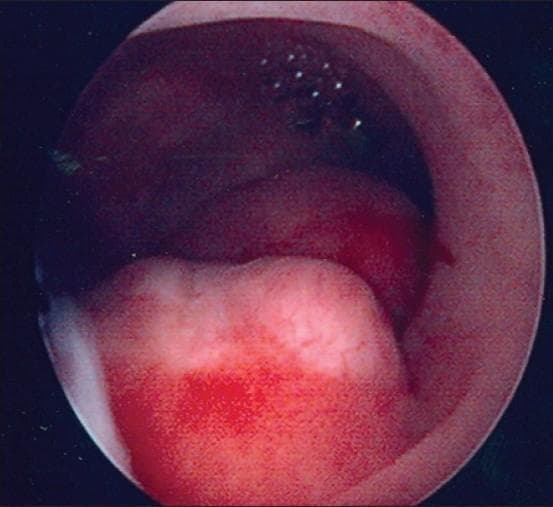 This clinical endoscopic image depicts a hysteroscopic view of the uterine cavity. The primary finding is a large, focal endometrial polyp characterized by a pale, whitish, and raised appearance that contrasts with the surrounding darker, vascularized endometrial tissue. The surface of the polyp shows irregular morphology and areas of focal reddish discoloration, suggestive of localized hemorrhage or hypervascularity. This diagnostic image demonstrates a common benign growth that can cause abnormal uterine bleeding (AUB) or postmenopausal bleeding (PMB). The visualization highlights the high sensitivity of hysteroscopy in detecting focal endometrial pathologies compared to transvaginal ultrasound, particularly in identifying the size, location, and vascular characteristics of endometrial polyps.