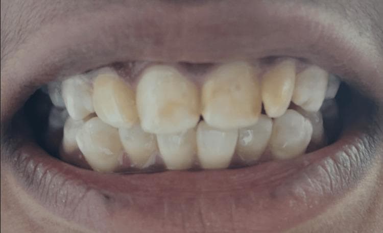 This intraoral clinical photograph displays the permanent dentition of a patient presenting with moderate dental fluorosis. The visual evidence shows a generalized, bilateral distribution of enamel hypomineralization across the maxillary and mandibular anterior teeth. Key findings include diffuse, chalky white opacities interspersed with prominent yellowish-brownish extrinsic staining, particularly localized on the labial surfaces and incisal thirds of the central and lateral incisors. The enamel lacks normal translucency, appearing opaque and mottled. While there is significant color alteration and surface irregularity, there is an absence of discrete pitting or large-scale structural loss of the enamel surface, characteristic of the moderate stage on the Dean's Fluorosis Index. This image serves as an educational example of how chronic fluoride ingestion during odontogenesis manifests as aesthetic dental defects and surface porosity.