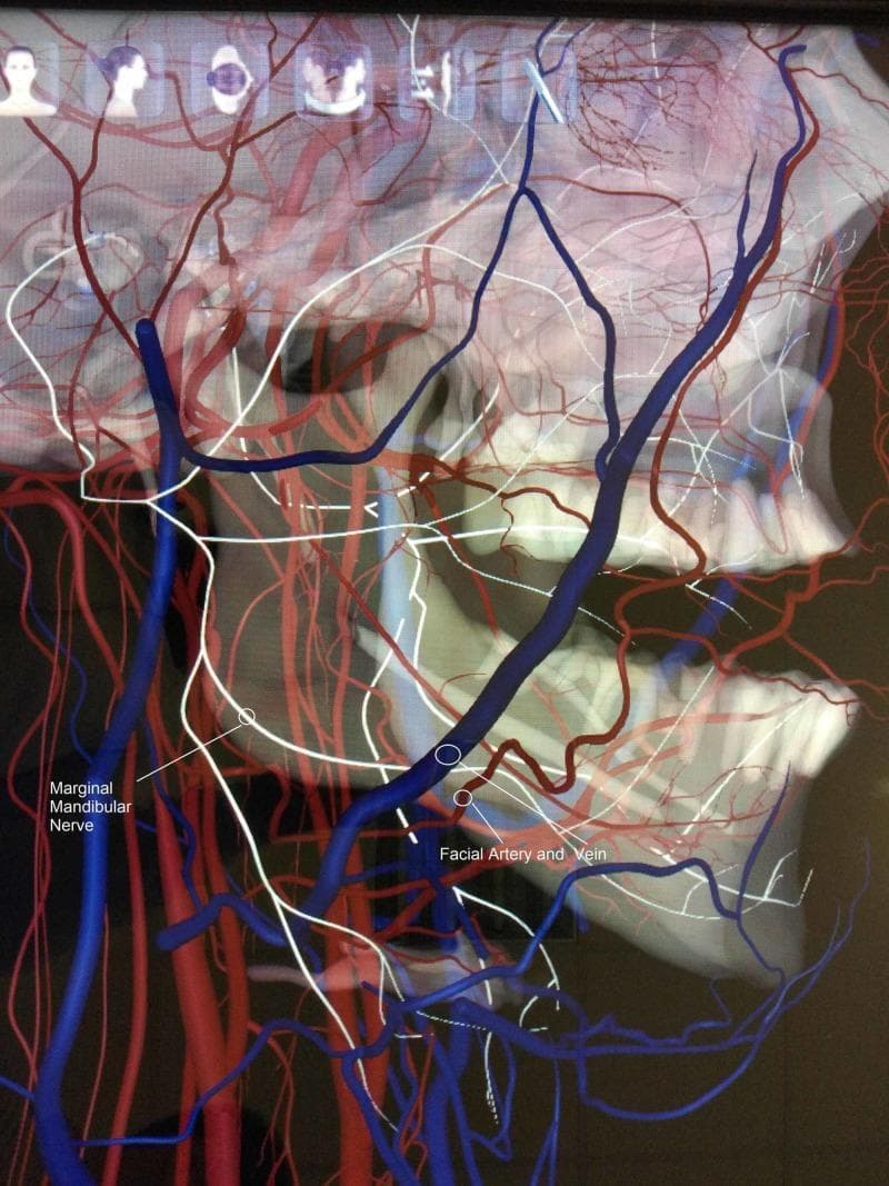 Anatomical diagram and 3D visualization illustrating a rare neurovascular anatomical variation in the maxillofacial region. This lateral view focuses on the right side of the mandible and cervical area, highlighting the spatial relationship between the marginal mandibular nerve (MMN), the facial artery, and the facial vein. The MMN is depicted as a blue tubular structure descending toward the lower border of the mandible. Crucially, the diagram demonstrates an atypical course where the MMN runs deep (medial) to the facial artery and vein (rendered in red), contrasting with the standard anatomical presentation where the nerve typically crosses superficial to these vessels. The visualization overlays these structures on a skeletal model of the skull and mandible, showing the nerve's proximity to the mandibular angle and body. This educational content is relevant for surgical anatomy, particularly in the context of neck dissections, submandibular gland excision, and rhytidectomy, where preserving the MMN is critical to prevent paralysis of the depressor muscles of the lower lip.