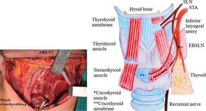 A composite medical visual consisting of a clinical intraoperative photograph (left) and a corresponding anatomical diagram (right) illustrating the anatomy of the neck and larynx. The content focuses on the anatomical variations of the External Branch of the Superior Laryngeal Nerve (EBSLN) in relation to the Superior Thyroid Artery (STA) and the thyroid gland, specifically representing Cernea Type IIb and Kierner Type III classifications. In the diagram, the EBSLN is shown descending alongside the STA and crossing it at a level below the upper pole of the thyroid gland, terminating in the cricothyroid muscle. Key labeled structures include the hyoid bone, thyrohyoid membrane/muscle, sternothyroid muscle, and cricothyroid membrane. The intraoperative photo displays the surgical field during thyroid surgery, with tissue retracted to expose the EBSLN in a clinical context. This material is designed for surgical education, highlighting the high-risk positioning of the nerve during the ligation of superior thyroid vessels.