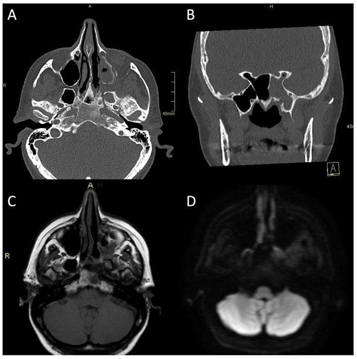 This composite diagnostic image showcases CT and MRI findings in a case of atypical bacterial skull-base osteomyelitis (ASBO). Panel A (axial CT bone algorithm) and Panel B (coronal CT bone algorithm) reveal significant bony alterations at the skull base, characterized by expansion of the left pterygopalatine fossa, opacification of the ipsilateral maxillary and sphenoid sinuses, and mixed erosive and hyperostotic changes. Panel B specifically highlights asymmetric expansion and destruction of the left Vidian canal. Panel C (axial MRI T1-weighted) demonstrates replacement of normal high-signal fatty marrow with low-signal edema in the clivus, while Panel D (axial MRI Diffusion-Weighted Imaging/DWI) shows restricted diffusion (increased signal) involving the left pterygoid base, pterygopalatine fossa, and infratemporal fossa. These multimodal findings illustrate the hallmark features of invasive sinogenic infection and osteomyelitis, emphasizing the use of high-resolution CT for cortical assessment and MRI for soft tissue and marrow involvement.