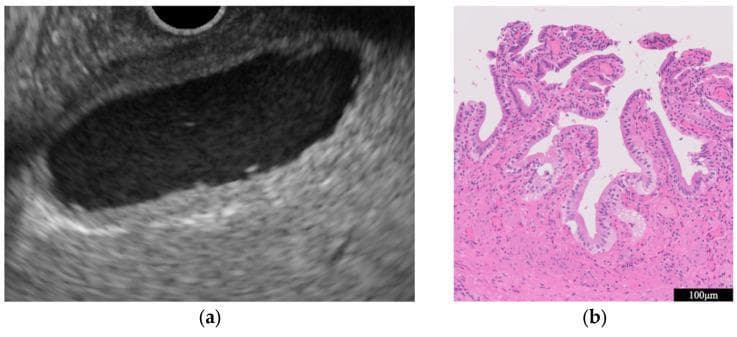 This composite image illustrates the clinical findings of chronic cholecystitis through two modalities: endoscopic ultrasound (EUS) and histopathology. Panel (a) is an ultrasound image of the gallbladder showing diagnostic features of chronic inflammation, characterized by uniform, circumferential thickening of the gallbladder wall while maintaining its layered structural integrity. The lumen is anechoic and free of significant masses. Panel (b) provides a histopathological correlation using Hematoxylin and Eosin (H&E) staining at a 100µm scale. It reveals a dense inflammatory cell infiltrate within the subepithelial layers, predominantly composed of lymphocytes. The gallbladder epithelium appears preserved and benign, specifically lacking atypical or dysplastic cells. This comparison is educationally significant for differentiating benign chronic inflammatory wall thickening from gallbladder carcinoma, where the wall structure is typically disrupted and cellular atypia is present.