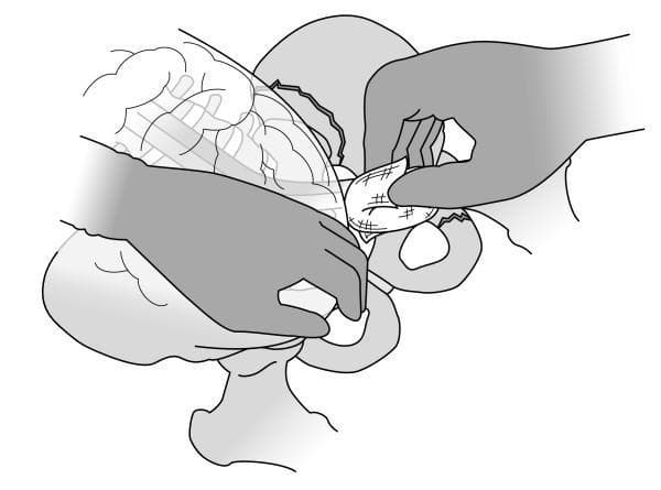 This medical illustration depicts a retroperitoneal pelvic packing procedure, typically used for hemorrhage control in cases of pelvic fracture. The line drawing shows a bimanual surgical technique within the left pelvic cavity. One hand is positioned medially and cranially, retracting the intact peritoneum and visceral contents (intestines) to create operative access to the retroperitoneal space. The second hand is shown inserting a surgical swab—illustrated with a cross-hatched texture indicating gauze—into the space adjacent to the pelvic ring. Key anatomical landmarks include the pelvic brim and the superior pubic ramus. The diagram emphasizes the manual dissection and packing of the pelvic sidewall down toward the coccyx. This visual serves as an educational guide for trauma surgery and emergency crisis management, specifically illustrating the sequence of manual retraction and tamponade via surgical packing following an extraperitoneal approach.