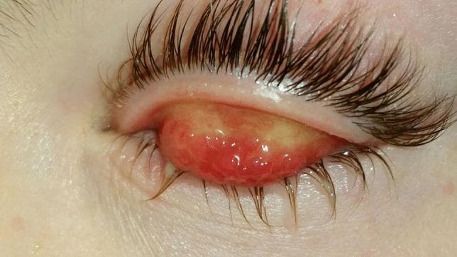 This clinical photograph displays a close-up view of a human eye with the upper eyelid everted to reveal the palpebral (tarsal) conjunctiva. The primary clinical finding is the presence of giant tarsal papillae, which are large, elevated, and closely packed, creating a distinctive 'cobblestone' appearance. The conjunctiva is highly hyperemic, exhibiting intense erythema, and shows interspersed areas of pale yellowish-white inflammatory exudate. The surrounding eyelids and eyelashes appear moist, suggestive of excessive lacrimation or mucoid discharge. This presentation is highly characteristic of the palpebral form of Vernal Keratoconjunctivitis (VKC), a chronic allergic inflammatory disease of the ocular surface. The image is a quintessential educational example of severe allergic conjunctivitis findings used in ophthalmology to differentiate inflammatory ocular surface disorders.