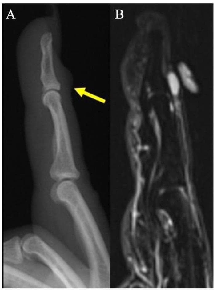 This composite figure provides a diagnostic comparison for a digital mucus cyst using two imaging modalities. Image A is a lateral plain radiograph of the index finger showing focal soft-tissue swelling (indicated by a yellow arrow) on the dorsal aspect of the distal interphalangeal (DIP) joint, located just proximal to the nail fold. There is no evidence of underlying bone erosion on the radiograph. Image B is a sagittal fat-suppressed proton density (PD) weighted MRI of the same finger. It reveals a small, well-circumscribed, uniformly hyperintense lesion consistent with a ganglion-type digital mucus cyst. The MRI confirms the absence of subungual extension or osseous erosion and demonstrates the cyst's location within the superficial soft tissues dorsal to the DIP joint. This visual material is used in medical education to differentiate between digital mucoid cysts, which are often associated with osteoarthritis and Heberden’s nodes, and other finger masses such as glomus tumors or giant cell tumors of the tendon sheath.