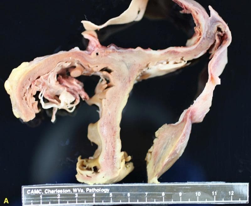 This clinical photograph displays a gross pathological cross-section of a human heart from an autopsy, illustrating a large left ventricular pseudoaneurysm (LVPA). The specimen shows a clear distinction between the true muscular wall of the left ventricle and the pseudoaneurysmal sac. The primary left ventricular myocardium is thick, measuring approximately 1 cm, with a solid muscular texture and reddish-tan coloration. In contrast, the pseudoaneurysmal walls, positioned in the upper right, are markedly thinned and lack myocardial layers. These pathological walls exhibit a more fibrous, less dense texture with yellowish-tan and pinkish-white hues, consistent with a sac composed of fibrin and organized thrombus rather than true endocardium and myocardium. The internal architecture reveals an irregular ventricular chamber shape and a fistulous tract or communication point leading to the pseudoaneurysm. This specimen demonstrates cardiac remodeling and morphological changes typical of a late-stage complication of infective endocarditis or myocardial injury, illustrating the high risk of rupture or heart failure associated with such large cardiac pseudoaneurysms.