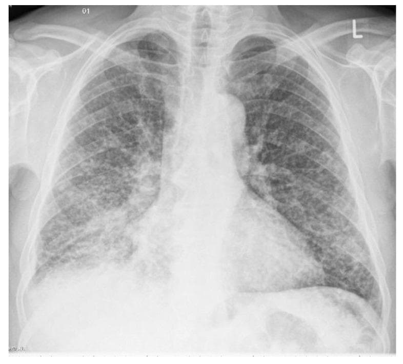 This diagnostic image is a posterior-anterior (PA) chest X-ray demonstrating miliary tuberculosis. The primary radiographic finding is a diffuse, bilateral, and uniform distribution of fine pulmonary nodules throughout both lung fields. These nodules are approximately 1–3 mm in diameter and are spread evenly from the apices to the lung bases, creating the characteristic 'miliary' (millet seed-like) pattern. The distribution involves all lobes without significant sparing, indicating hematogenous dissemination of Mycobacterium tuberculosis. The lung parenchyma shows a granular texture due to the density of these nodules. Cardiac silhouette and mediastinal contours appear within normal limits in this view, and no obvious pleural effusions are noted. This image serves as a classic educational example of miliary pulmonary involvement, emphasizing the importance of recognizing diffuse micronodular patterns in infectious disease diagnostics.