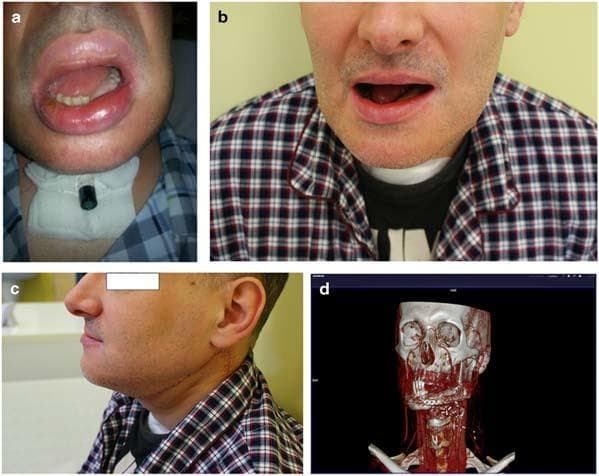 A multi-panel medical image series documenting mandibular reconstruction for advanced oral squamous cell carcinoma. Panel (a) shows a clinical photograph one week post-surgery, featuring significant perioral edema and a tracheostomy tube with a speaking valve secured by a neck dressing. Panels (b) and (c) provide frontal and lateral views of the patient two months post-operatively, demonstrating favorable aesthetic outcomes, restoration of facial symmetry, and healed surgical scars following partial mandibular resection and fibular free flap reconstruction. Panel (d) displays a 3D CT reconstruction of the head and neck, highlighting the surgical hardware including a contoured titanium reconstruction plate and screws stabilizing the osseous fibular graft to the remaining mandible. The reconstruction integrates 3D model printing technology to restore the mandibular contour and floor of the mouth. The series illustrates the clinical evolution from the immediate post-operative phase to functional recovery in complex maxillofacial reconstructive surgery.