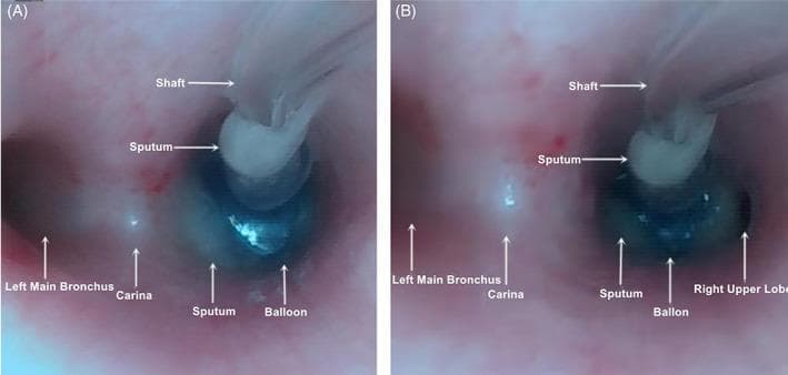 Fiberoptic bronchoscopy images demonstrating the placement of a bronchial blocker (BB) at the carina for one-lung ventilation. Both images (A) and (B) show the bronchial tree landmarks including the carina, the left main bronchus, and the blocker's shaft and balloon cuff. In image (A), the inflated blue balloon demonstrates optimal position, achieving complete occlusion of the right main bronchus. In image (B), the balloon is malpositioned or under-inflated, resulting in incomplete occlusion and visible patency of the right upper lobe bronchus. White, viscous sputum is present near the blocker shaft and within the bronchial lumen in both views. This comparison serves as an educational tool for verifying bronchial blocker placement and identifying common causes of failed lung isolation, such as cuff displacement or insufficient inflation, which can be correlated with bedside lung ultrasound findings.