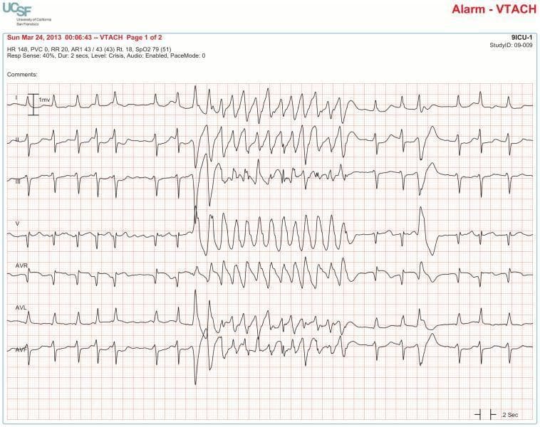 This diagnostic image displays a 10-second multi-lead electrocardiogram (ECG) rhythm strip illustrating a true positive ventricular tachycardia (VT) alarm. Seven leads are shown in sequence: I, II, III, V, aVR, aVL, and aVF. The initial segment of the tracing demonstrates an underlying rhythm of atrial fibrillation characterized by irregularly irregular R-R intervals and a rapid ventricular rate (approximately 140 bpm). An isolated ventricular premature contraction (VPC) is visible midway through the strip. This VPC exhibits a morphology identical to the subsequent run of wide-complex tachycardia, which confirms the diagnosis of ventricular tachycardia. During the VT episode, the QRS complexes become significantly widened and aberrant, occurring at a rapid, regular rate before spontaneously terminating and returning to the underlying atrial fibrillation. This tracing is a critical educational example used to distinguish true ventricular arrhythmias from artifact by correlating ectopic beat morphology with the onset of the tachycardia across multiple simultaneous leads.