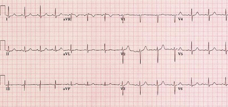 A standard 12-lead electrocardiogram (ECG) displayed on a red grid background, representing a diagnostic image for cardiovascular assessment. The tracing shows a normal sinus rhythm with consistent P-wave morphology followed by QRS complexes. The QRS complexes are relatively narrow (less than 120 ms), indicating normal ventricular depolarization, and appear upright in the lateral leads (I, aVL, V5, V6) and inferior leads (II, III, aVF). T-waves are generally upright and exhibit normal amplitude across most leads, with expected inversion in lead aVR. There is no evidence of ST-segment elevation or depression, pathological Q-waves, or significant rhythm disturbances. This ECG is used in a clinical education context to demonstrate findings within normal limits for a patient presenting with metabolic alkalosis, helping learners rule out cardiac causes for altered mental status such as arrhythmias or electrolyte-induced conduction delays.
