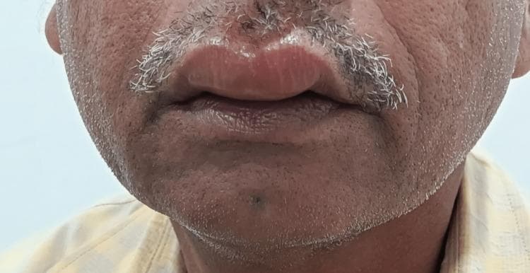 This clinical photograph displays a front-facing view of a patient's lower face, highlighting marked swelling of the lips (cheilitis). The upper lip exhibits significant edematous distension with a smooth, shiny surface and erythematous discoloration, which is characteristic of angioedema. The lower lip also shows moderate swelling. The cutaneous area immediately below the lower lip and extending toward the chin appears mildly inflamed with subtle soft tissue edema. This presentation is consistent with a Cutaneous Adverse Drug Reaction (CADR), specifically drug-induced angioedema secondary to the cephalosporin antibiotic cefixime. The image illustrates the typical localized, non-pitting edema of the deep dermis and subcutaneous tissues frequently seen in Type I hypersensitivity reactions or other drug-mediated inflammatory responses.
