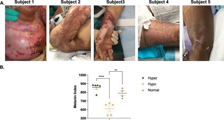 This composite educational image illustrates post-burn hypertrophic scarring (HTS) and associated dyschromia. Panel A contains five clinical photographs (Subjects 1–5) showing heterogeneous skin pigmentation on the torso and extremities. The photographs demonstrate a range of clinical findings, including hyperpigmented (darkened) and hypopigmented (depigmented) patches, mottled skin patterns, and raised, thickened scar tissue characteristic of hypertrophic remodeling. Panel B presents a dot plot quantifying the Melanin Index across three clinical phenotypes: hyperpigmented scar, hypopigmented scar, and normal skin (n=5). The data shows that hyperpigmented areas have the highest melanin content (mean ~875), followed by normal skin (mean ~800), and hypopigmented areas (mean ~625). Statistical significance is indicated, with p<0.01 between hyper- and hypopigmented groups and p<0.0001 between hyperpigmented and normal skin. This material serves to correlate clinical visual manifestations of post-burn dyschromia with objective non-invasive skin probe measurements, highlighting the physiological variability in melanin distribution following severe cutaneous injury.