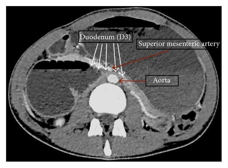 An axial contrast-enhanced CT scan of the abdomen demonstrating the hallmark anatomical findings of Superior Mesenteric Artery (SMA) syndrome. The image highlights the compression of the third part of the duodenum (D3) as it passes through the narrow aortomesenteric angle, formed between the abdominal aorta posteriorly and the superior mesenteric artery anteriorly. Key landmarks include the hyperdense, contrast-filled circular lumen of the aorta and the smaller SMA originating from its anterior wall. The D3 segment is visibly narrowed (beaked) at the midline. Secondary signs of high-grade proximal obstruction are evident, including a markedly distended stomach and dilated proximal duodenum. The scan also provides visualization of the left renal vein in close proximity, relevant for the 'Nutcracker phenomenon' associated with this vascular geometry. This diagnostic image is intended for educational use in gastroenterology and radiology to illustrate the mechanism of vascular compression leading to duodenal obstruction.