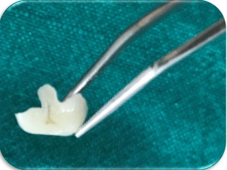 A procedural photograph from a dental laboratory perspective showing a custom-fabricated ceramic onlay for tooth 16. The tooth-colored restoration is held by metallic dental forceps against a blue-green background. The onlay displays complex occlusal morphology, including anatomically contoured cusp-like projections and defined grooves to mimic natural posterior tooth anatomy. The ceramic material exhibits high translucency and a polished, smooth surface texture. The margins appear thin, well-defined, and precisely finished to ensure an accurate fit for the prepared cavity. This image illustrates an indirect aesthetic restoration designed to manage extensive cuspal fractures and caries in conservative dentistry.