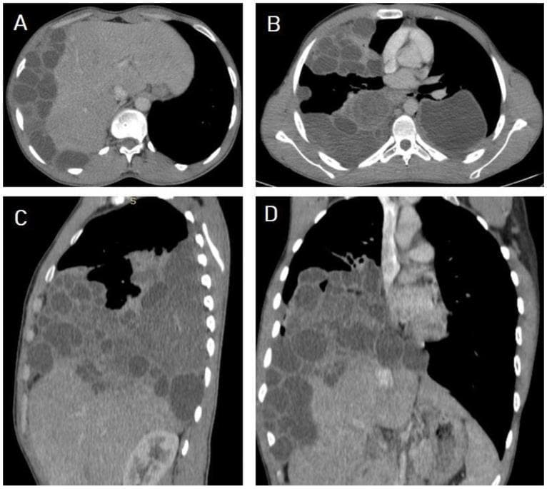 This set of non-contrast Computed Tomography (CT) images illustrates a case of disseminated echinococcosis (hydatid disease) in a 40-year-old male. Image A (axial section, abdomen) shows the liver with multiple well-circumscribed, hypodense cystic lesions consistent with WHO-IWGE CE2 type hydatid cysts containing internal daughter vesicles. There is evidence of hepatic cyst rupture with subsequent peritoneal dissemination. Images B (axial), C (sagittal), and D (coronal) of the chest reveal extensive bilateral pulmonary and pleural involvement. Multiple rounded, thin-walled cystic lesions of varying sizes occupy a significant portion of both lung fields, particularly on the right side. The distribution suggests secondary hematogenous or transdiaphragmatic seeding from the primary hepatic source. Key features include the multilocular cystic appearance, absence of significant perilesional edema, and widespread dissemination across the diaphragm into the thoracic cavity. This imaging demonstrates advanced complicated hydatid disease with catastrophic multisystemic involvement, useful for educational review of parasitic dissemination pathways and CT morphology of Echinococcus granulosus infections.