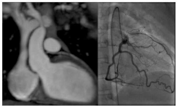 A side-by-side comparison of two cardiac imaging modalities demonstrating coronary artery anatomy. The left image is a 3D Magnetic Resonance Coronary Angiography (MRCA) utilizing a b-SSFP whole-heart sequence. It provides a volume-rendered overview of the cardiac chambers, the ascending aorta, and the pulmonary artery, specifically highlighting the absence of a normal origin for the left coronary artery from the left aortic sinus of Valsalva. The right image is a conventional X-ray coronary angiography frame, showing the detailed lumen of the coronary arterial tree with contrast opacification. The angiography reveals the branching pattern of the coronary arteries, including the left anterior descending and circumflex systems, and serves as definitive confirmation of the anatomical anomalies or obstructions suggested by the non-invasive MRCA. This comparison is used in cardiovascular medicine to assess complex congenital anomalies, surgical outcomes like the Takeuchi repair, or suspected coronary artery stenosis and obstruction.
