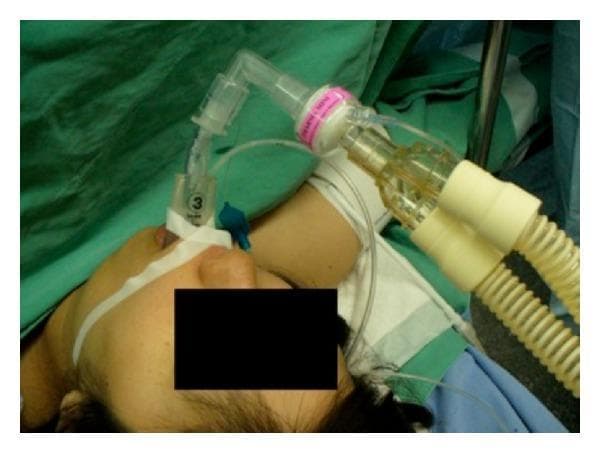 This clinical photograph illustrates a complex airway management setup in an anesthetized patient. A size 3 I-gel supraglottic airway device is positioned in the oropharynx and secured with white adhesive tape across the patient's face. Inserted through the I-gel is a Parker tracheal tube, demonstrating the use of a supraglottic device as a conduit for endotracheal intubation. The airway circuit includes a clear right-angled connector attached to a Heat and Moisture Exchange (HME) filter (pink and white), which subsequently connects to a dual-limb corrugated ventilator breathing circuit. A thin nasogastric tube is visible, running alongside the airway equipment through the gastric channel of the I-gel for gastric decompression. This image is medically significant for teaching advanced airway techniques, specifically the transition from a supraglottic airway to definitive tracheal intubation under general anesthesia in a surgical setting.