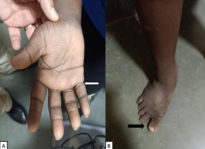 Clinical photographs showing characteristic dysmorphic features associated with Trisomy 21 (Down syndrome). Panel A illustrates the palmar aspect of the left hand, highlighting a short and broad hand morphology, a single transverse palmar crease (simian crease), and clinodactyly (incurving) of the shortened fifth finger. Panel B shows the patient's foot from a dorsal view, demonstrating a prominent 'sandal gap' deformity, which is a widened space between the first (hallux) and second toes. These physical findings are classic phenotypic markers used in the clinical diagnosis of genetic trisomy. The images serve as educational visual aids for identifying common musculoskeletal and dermatoglyphic manifestations of chromosomal abnormalities during a physical examination.