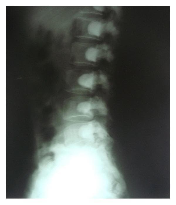 This lateral lumbar spine radiograph demonstrates a significant, generalized increase in bone density (osteosclerosis) across all visible vertebral levels. A hallmark radiographic feature known as the 'bone-within-bone appearance' (endobone) is present, where a dense, well-defined silhouette of a smaller vertebral body appears nested within the outer cortical margins of each vertebra. This phenomenon is caused by systemic failure of normal bone remodeling, resulting in the persistence of primary spongiosa. Despite the marked sclerosis and loss of normal trabecular detail, the overall morphology, height, and alignment of the vertebral bodies, as well as the spinous processes, appear relatively preserved. Such findings are characteristic of sclerosing bone dysplasias, most notably osteopetrosis (Albers-Schönberg disease). This diagnostic image serves as an educational example of how systemic mineralization disorders manifest in the axial skeleton, emphasizing the distinction between increased radiographic density and actual structural integrity.