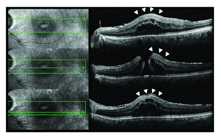 Diagnostic optical coherence tomography (OCT) of the human retina demonstrating a full-thickness macular hole (FTMH) associated with lamellar macular hole-associated epiretinal proliferation (LHEP). The image presents a composite of three vertical pairs: the left panel shows infrared fundus images with green horizontal scan lines indicating the cross-sectional path, while the right panel shows corresponding B-scan OCT images. The central OCT scan clearly reveals a full-thickness defect in the fovea extending from the internal limiting membrane (ILM) through to the photoreceptor layer. Distinctive features include a 'fluid cuff' surrounding the edges of the FTMH, marked by white arrowheads, which appears as hyporeflective intraretinal cystic spaces indicative of subretinal and intraretinal fluid accumulation. The hole exhibits an hourglass morphology where the minimum diameter is situated in the middle retinal layers. There is a notable disruption of the ellipsoid zone (EZ) and external limiting membrane (ELM) at the base of the hole. This visual is significant for diagnosing advanced macular pathology and planning surgical vitreoretinal intervention.