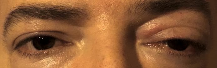 This clinical photograph provides a comparative view of the periocular region, highlighting unilateral pathology of the left eye. The right eye serves as a healthy control, showing normal orbital position, eyelid margin, and scleral appearance. In contrast, the left eye demonstrates significant proptosis (anterior displacement of the globe). Associated adnexal findings include pronounced edema and erythema of the upper eyelid, resulting in mechanical ptosis. The visible conjunctiva exhibits mild hyperemia (increased vascularity) and chemosis (conjunctival edema). These findings are characteristic of orbital inflammatory processes, such as orbital cellulitis, thyroid eye disease, or orbital pseudotumor. The image serves as an educational tool for identifying clinical signs of space-occupying or inflammatory lesions within the orbit, emphasizing the distinction between globe displacement and eyelid-specific pathology in ophthalmology and emergency medicine contexts.