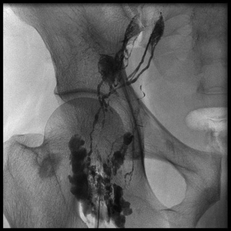 This diagnostic fluoroscopic image is a groin lymphangiogram utilizing Lipiodol contrast. The radiograph displays the anatomical distribution of the inguinal lymphatic system in relation to the pelvic skeletal structures, including the iliac bone, acetabulum, and proximal femur. Opacified lymphatic vessels appear as thin, branching linear channels that ascend from the femoral region toward the pelvis. Multiple dense, lobulated clusters represent contrast-filled superficial and deep inguinal lymph nodes. The nodes vary in morphology and contrast density, with some showing intense opacification indicating successful uptake. The vessels track along the expected medial aspect of the thigh and course superiorly toward the external iliac chain. This imaging modality is typically used for investigating lymphatic leaks, such as chylothorax or chylous ascites, and for guiding interventions like thoracic duct embolization. The image demonstrates normal and variant branching patterns of the lymphatic network essential for procedural planning in interventional radiology.