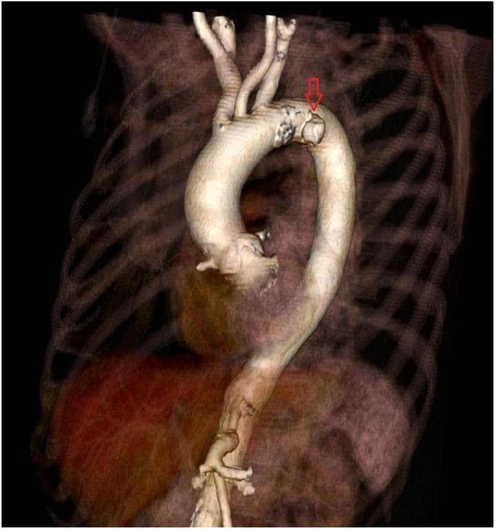 A 3D volume-rendered Computed Tomography (CT) reconstruction of the aorta and surrounding thoracic structures. The image provides a detailed view of the entire aortic path, starting from the abdominal segment and ascending through the thoracic cavity to form the aortic arch. The three major supra-aortic branches—the brachiocephalic trunk, left common carotid artery, and left subclavian artery—are visible at the superior aspect of the arch. A prominent red arrow points to a focal outpouching or intimal irregularity located on the outer curvature of the distal aortic arch, characteristic of a penetrating aortic ulcer (PAU). The surrounding bony anatomy, including the ribs and vertebrae, is rendered with semi-transparency to provide anatomical context without obscuring the vascular pathology. This diagnostic image is intended for pre-procedural planning, demonstrating the specific morphology and localization of an atherosclerotic lesion within the aortic wall that carries a clinical risk of progression to dissection or rupture.