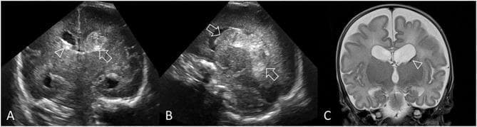 This composite figure illustrates a case of Grade III germinal matrix hemorrhage-intraventricular hemorrhage (GMH-IVH) in a preterm infant through cranial ultrasound (cUS) and follow-up MRI. Panel A is a coronal cUS at the level of the lateral ventricular bodies, showing a large, hyperechoic left-sided hemorrhage (arrow) causing acute distension and ventriculomegaly. A smaller amount of hyperechoic blood is visible in the right lateral ventricle (arrowhead), which exhibits 'ballooning' of the frontal horn. Panel B is a parasagittal cUS demonstrating that the echogenic clot occupies more than 50% of the distended left lateral ventricle, consistent with Grade III IVH. Panel C shows a coronal T2-weighted MR image taken 3 months post-birth, revealing sequelae of the hemorrhage. Notable findings include subtle hypointense staining at the left caudothalamic notch (arrowhead), indicating hemosiderin deposition. There is persistent, asymmetrical ventriculomegaly and widened subarachnoid spaces, reflecting ex-vacuo changes secondary to cerebral tissue volume loss.