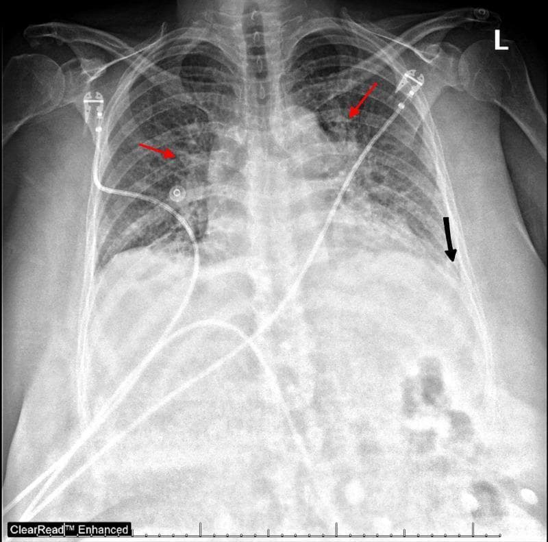 This diagnostic image is an anteroposterior (AP) chest radiograph illustrating acute pulmonary edema and associated pleural findings. The lung fields demonstrate diffuse, bilateral hazy opacities with a predominant perihilar (bat-wing) distribution (highlighted by red arrows), characteristic of alveolar and interstitial fluid accumulation. The pulmonary vasculature appears prominent, and the cardiac silhouette is mildly enlarged, suggesting cardiogenic origin. Small bilateral pleural effusions are evidenced by the blunting of the costophrenic angles (indicated by the black arrow on the left). Several medical support devices are visible, including external electrocardiogram (ECG) leads and a central venous catheter or similar indwelling line coursing through the superior vena cava toward the right atrium. The image serves as a clinical example of congestive heart failure manifestations in an acute setting. Key educational concepts include recognizing patterns of pulmonary vascular congestion, distinguishing between interstitial and alveolar edema, and identifying secondary signs such as pleural effusion and cardiomegaly on a portable x-ray.