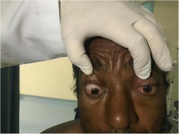 This clinical photograph shows a close-up frontal view of a patient's face during an ophthalmic examination, focusing on bilateral ocular pathology. A gloved hand is visible retracting the upper eyelids to reveal significant abnormalities. The left eye exhibits prominent proptosis (axial bulging) and severe chemosis (conjunctival edema), with marked ciliary injection and diffuse conjunctival erythema. There is evidence of matted eyelashes and purulent discharge along the lid margins. The right eye also demonstrates eyelid edema and conjunctival injection, though to a lesser degree than the left. The patient shows signs of ophthalmoplegia, as evidenced by a fixed, downward-turned gaze in the right eye despite attempted examination. These visual findings are highly characteristic of orbital cellulitis, potentially secondary to paranasal sinusitis. The image serves as an educational tool for identifying clinical red flags of orbital inflammation, including proptosis, chemosis, and impaired extraocular motility.