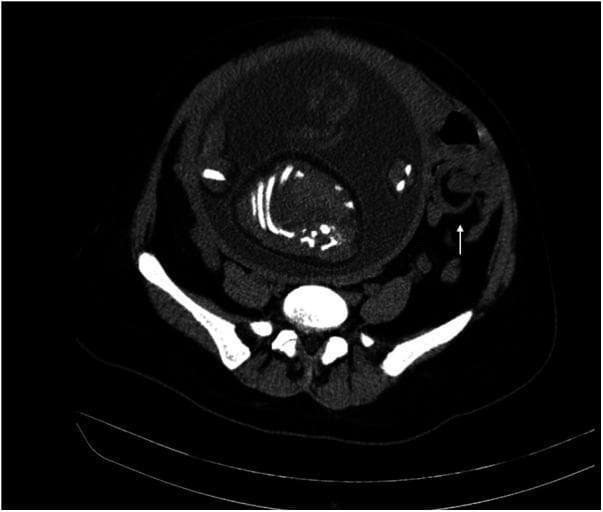 This axial computed tomography (CT) scan of the abdomen and pelvis demonstrates a classic 'whirl sign' or 'vortex sign' in the left lower quadrant, indicated by a white arrow. This sign is characterized by the swirling appearance of the small intestinal loops, mesenteric fat, and vasculature, which is highly suggestive of midgut volvulus or small bowel torsion. Adjacent to the site of torsion, the intestinal lumen shows signs of localized dilation. The scan also reveals a large, gravid uterus occupying the central and anterior abdominal cavity, containing a fetus with visible hyperdense skeletal elements. This clinical scenario represents a rare but critical surgical emergency: small bowel volvulus occurring during pregnancy. The surrounding anatomical structures include the posterior vertebral column and the pelvic girdle. This image is an essential educational resource for understanding the radiological manifestations of acute mechanical bowel obstruction in the setting of advanced gestation.