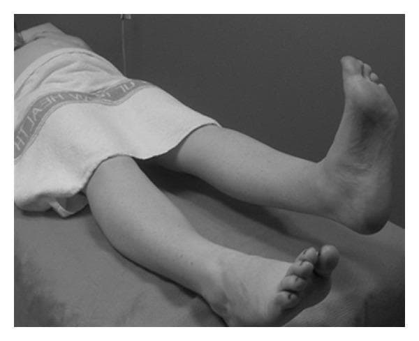 A clinical photograph in grayscale demonstrating the Active Straight Leg Raise (ASLR) test, an orthopedic and physical examination maneuver used to assess pelvic girdle pain (PGP) and lumbo-pelvic stability. The subject is positioned supine on an examination table with a towel draped over the pelvic region for privacy. The image shows the patient actively elevating one lower extremity while maintaining full knee extension and ankle dorsiflexion, while the contralateral leg remains resting in a neutral position on the table. This test evaluates the ability of the pelvic floor and trunk muscles to effectively transfer loads through the pelvis. It is clinically significant in obstetrics and physical therapy for diagnosing lumbopelvic pain and predicting functional disability in pregnant and postpartum populations.