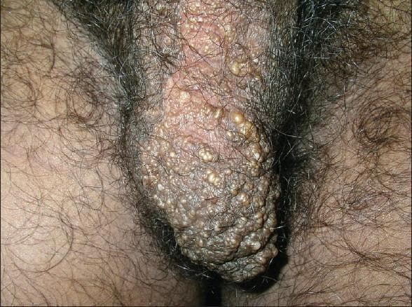 Clinical photograph of the male genital region, specifically showing the scrotum. The image depicts a localized cluster of numerous small, translucent to whitish-yellow vesicles on the left side of the scrotum. These lesions, characteristic of lymphangioma circumscriptum (LC), appear as multiple, thin-walled, fluid-filled papules resembling 'frog spawn.' The vesicles vary in size and are set against a background of skin that exhibits secondary changes, including hyperpigmentation and a thickened, pebbly, or verrucous (wart-like) texture. Some vesicles appear slightly more prominent and pearly, while the surrounding scrotal skin shows normal hair distribution. The clinical presentation is consistent with superficial lymphatic malformation, demonstrating clustered lymphangiectasias that may occasionally ooze clear or blood-tinged serous fluid (lymphorrhea).