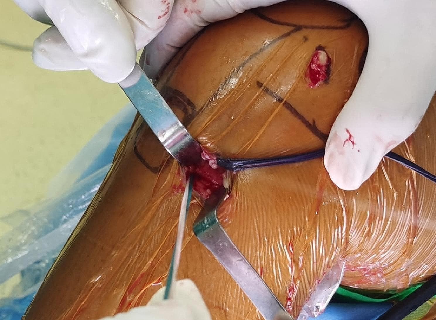 This clinical photograph captures an intraoperative view of an anterior cruciate ligament (ACL) reconstruction or augmentation procedure focusing on the distal tibial attachment site. The surgical field demonstrates a primary incision site near the tibial tuberosity, held open by metallic retractors to expose subcutaneous tissue and the graft stump. A secondary, smaller 1 cm incision is visible superiorly, likely corresponding to the femoral tunnel exit or an accessory portal. High-tensile traction sutures (Ethibond No. 2, visible in blue and white) are utilized to secure the distal end of the graft, forming a loop structure as part of a specialized fixation technique. The skin is prepped with an orange-tinted iodine-based antiseptic and covered with a transparent surgical drape. Surgical marking pen lines delineate anatomical landmarks such as the patella and joint line. The image illustrates a critical step in ligamentous graft tensioning and fixation within orthopedic surgery, highlighting the integration of the graft with the native tibial footprint.
