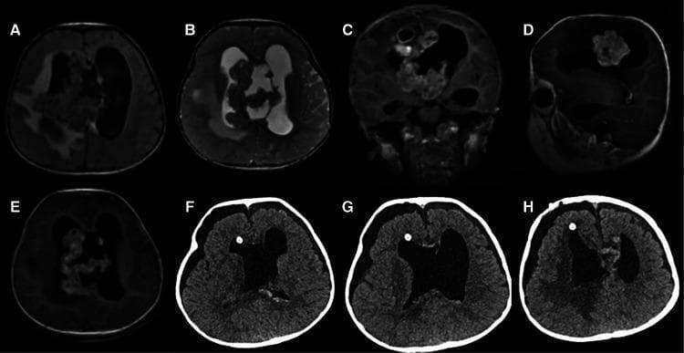 This composite figure displays preoperative MRI and postoperative CT scans of a pediatric brain tumor, specifically an Atypical Teratoid/Rhabdoid Tumor (AT/RT). Preoperative MRI sequences (A-E) show a large, irregular mass centered in the right lateral ventricle with intraventricular extension and secondary hydrocephalus. The tumor appears isointense on axial T1 (A) and T2-weighted (B) images. Following gadolinium administration, coronal (C), sagittal (D), and axial (E) T1-weighted images demonstrate heterogeneous hyperintense contrast enhancement and cystic or necrotic components. The mass occupies a significant portion of the lateral ventricles and extends toward the third ventricle. Postoperative axial CT scans (F-H) illustrate the results following gross total resection. Key findings include bilateral ventricular enlargement and several nodular, high-density foci along the ventricular walls, representing postoperative changes, surgical material, or potential residual calcified abnormalities. A hyperdense shunt or drain tip is visible in the right frontal horn. These images serve as an educational example of intraventricular embryonic tumors and the importance of multi-planar imaging in surgical planning and postoperative evaluation.