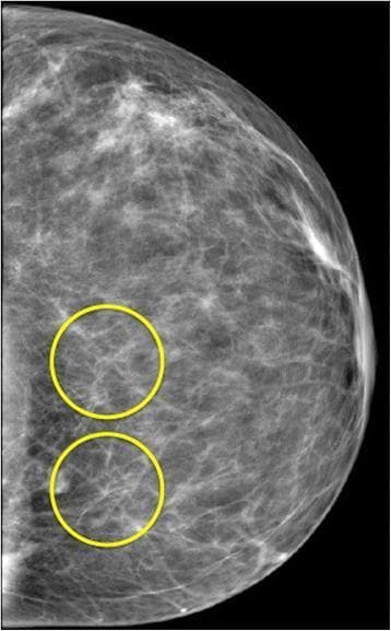 This diagnostic image is a mammogram, specifically a craniocaudal or mediolateral oblique view of the breast, rendered in a standard grayscale format. The image demonstrates the complex internal anatomy of the breast, characterized by heterogeneous fibroglandular tissue. Visible are fine, radiopaque thread-like filaments representing Cooper's ligaments and stromal connective tissue, which form a web-like or reticular pattern throughout the adipose background.
Two yellow circles are superimposed on the lower-inner/central region of the tissue. These circles highlight areas of significant structural overlap where multiple thin filaments intersect. These points of intersection create localized focal densities that appear brighter (more radiopaque) than the surrounding stroma. Educationally, this image is used to illustrate the concept of anatomical superposition or 'summation artifacts' in 2D projection imaging, where overlapping normal structures can mimic pathological findings. The visual is relevant for radiologists and medical students learning to differentiate between true structural lesions, such as masses or architectural distortion, and the accidental superposition of benign fibrous tissues in a 3D volume.
