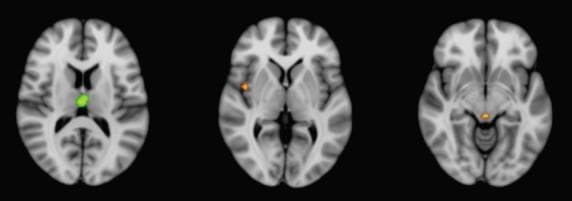 This diagnostic image displays three axial neuroimaging slices superimposed on the MNI-152 brain template, illustrating results from a conjunction analysis of gray matter atrophy in atypical parkinsonian syndromes (APS). The visualization identifies overlapping regions of volume loss between distinct disease groups. The leftmost slice shows a green-colored cluster in the superomedial thalamus, indicating shared atrophy common to corticobasal degeneration (CBD) and progressive supranuclear palsy (PSP). The middle slice reveals an orange cluster localized to the right insula (Brodmann Area 13), while the rightmost slice depicts an orange cluster in the midbrain; these orange regions signify shared gray matter reduction between progressive supranuclear palsy (PSP) and multisystem atrophy Parkinson-type (MSA-P). This neuroanatomical comparison serves as an educational tool for identifying common neurodegenerative patterns and distinguishing shared pathological involvement among APS variants, highlighting the thalamus, insula, and midbrain as critical areas of convergence for different parkinsonian disorders.