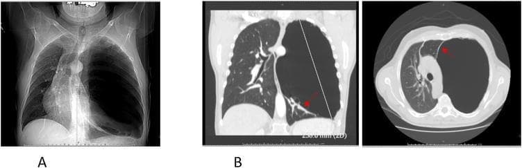 This composite of diagnostic images demonstrates a giant pulmonary bulla in the left lung, a key clinical finding in advanced emphysematous disease. Panel A is a preoperative posteroanterior chest X-ray showing a massive, hyperlucent, air-filled space in the left hemithorax. The bulla causes significant mass effect, leading to a rightward mediastinal shift and compression of the contralateral lung. Panel B presents thoracic CT images in coronal and axial planes. These scans better characterize the bulla as a large, thin-walled, air-containing structure measuring approximately 10.5 x 11 cm. Red arrows in the CT views highlight the 'double-wall sign,' where air within the bulla and air in the adjacent pleural space (if a pneumothorax is present) or another adjacent bulla outline the thin visceral wall. The CT illustrates how the bulla compresses the fairly normal surrounding lung parenchyma and deviates the trachea and heart toward the right. This visual sequence is intended to teach the differentiation between a giant bulla and a tension pneumothorax, utilizing specific radiographic signs to guide appropriate surgical or emergency management.