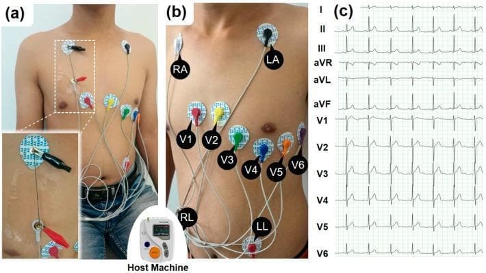 This composite educational graphic illustrates the procedural setup and resulting data for a standard 12-lead electrocardiogram (ECG/EKG). Panels (a) and (b) are clinical photographs demonstrating correct electrode placement on a male torso. The limb leads are positioned as RA (right arm/shoulder) and LA (left arm/shoulder) on the upper chest, with RL (right leg) and LL (left leg) on the lower abdomen. The precordial leads (V1-V6) follow the standard anatomical arc across the chest: V1 and V2 at the fourth intercostal space (right and left of the sternum), V4 at the fifth intercostal space (mid-clavicular line), and V3, V5, and V6 completing the transverse sequence toward the left axilla. Panel (a) includes an inset showing the experimental use of conductive carbon nanotube yarns (SWNT-CYs) connected via alligator clips to the electrodes. Panel (c) displays the resulting 12-lead ECG waveforms on a standard grid, labeled I, II, III, aVR, aVL, aVF, and V1-V6. Each lead shows distinct P-waves, QRS complexes, and T-waves, representing different electrical vectors of cardiac depolarization and repolarization.