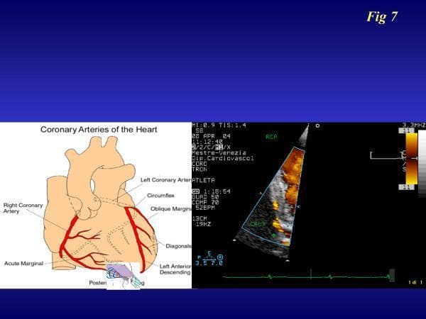 A dual-panel medical illustration and diagnostic image set demonstrating the transthoracic imaging of the right coronary artery (RCA). The left panel is an anatomical diagram of the 'Coronary Arteries of the Heart,' highlighting the major epicardial vessels including the Right Coronary Artery, Acute Marginal artery, Left Coronary Artery, Circumflex, Oblique Marginal, Diagonals, and Left Anterior Descending (LAD) artery. The right panel is a color Doppler transthoracic echocardiogram (TTE) in a specialized apical off-axis view. It displays real-time blood flow within the RCA, labeled as 'RCA' and 'CRUX' (indicating the crux of the heart), represented by a red and yellow color scale signifying flow velocity. A vertical color velocity bar and an electrocardiogram (ECG) trace are visible on the periphery. This comparison is used to guide non-invasive assessment of coronary flow reserve (CFR) by correlating anatomical landmarks with functional Doppler flow signals in a clinical cardiology setting.