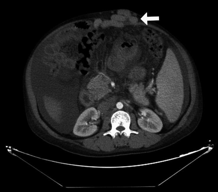 Axial contrast-enhanced CT scan of the abdomen at the level of the kidneys. A prominent white arrow points to significantly dilated, tortuous periumbilical (paraumbilical) veins located within the anterior abdominal wall, representing a 'caput medusae' appearance typical of portal hypertension. The image shows moderate to large volume ascites, visualized as low-attenuation fluid surrounding the liver and spleen. The spleen is noticeably enlarged (splenomegaly). Other visualized structures include the liver, both kidneys, the vertebral column with the adjacent abdominal aorta and inferior vena cava, and bowel loops. This diagnostic image is characteristic of chronic liver disease with secondary portal hypertension and established collateral venous circulation.