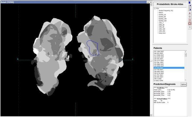 A clinical software interface displaying a Probabilistic Stroke Atlas (PSA) designed for patient-specific outcome prediction. The main viewer displays an axial grayscale image of a normalized brain representation, specifically a 90-day modified Rankin Scale (mRS90) map. The image shows non-uniform intensity distributions across both hemispheres, where varying grayscale shades represent the spatial probability of functional outcomes. A blue contour is superimposed over the left hemisphere, delineating the normalized infarcted region for the case under prediction. The right-hand sidebar contains three functional panels: an upper selector for probabilistic parameters (e.g., NIHSS, Barthel Index, mRS at various intervals), a middle panel for patient case selection, and a lower 'Prediction/Diagnosis' panel. The prediction panel displays statistical data for the selected case, including a mean predicted mRS90 score of 4.25, percentile distributions, and actual clinical values (Age: 90, NIH Stroke Scale: 4). This tool illustrates the integration of neuroradiological scan data with clinical scoring systems for predictive stroke modeling.