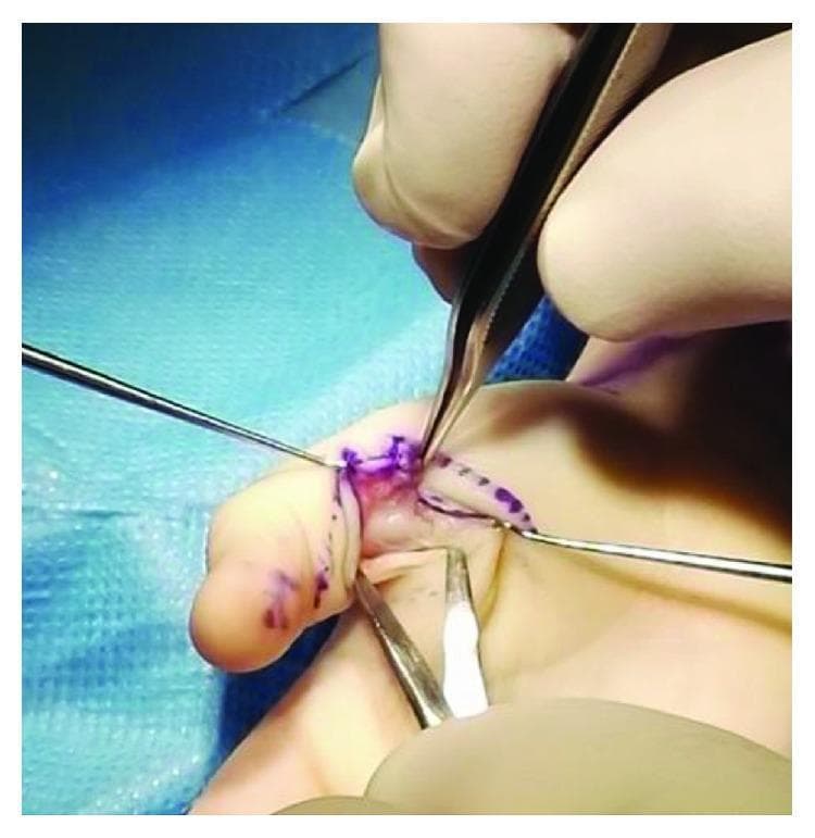 This clinical photograph captures an intraoperative view of a surgical procedure on a human digit, specifically an A1 pulley release to treat a trigger thumb. The primary anatomical focus is the flexor tendon sheath at the level of the metacarpophalangeal joint. Centrally, a 'Node of Notta'—a pathological nodular thickening of the flexor pollicis longus tendon—is exposed and being manipulated with fine surgical forceps. The surgical field is prepared with blue sterile drapes and shows purple skin markers delineating the incision path. Multiple microsurgical instruments, including adson-type forceps and a fine probe or retractor, are visible in the hands of the surgeon (gloved). The image demonstrates the classic clinical presentation of pediatric stenosing tenosynovitis where the enlarged tendon nodule becomes trapped proximal to the A1 pulley, causing mechanical locking of the joint. This visual is highly relevant for orthopedic and hand surgery education, specifically regarding the surgical management of congenital or developmental trigger digits.