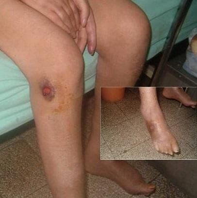 This clinical photograph demonstrates a localized lower extremity ulceration, specifically located on the anterior surface of the right leg distal to the knee. The primary lesion is a circular, punched-out ulcer with a deep red, granulated base and raised, hyperpigmented, indurated borders suggestive of localized inflammation or necrosis. The surrounding perilesional skin displays brownish-yellow hyperpigmentation and xerosis. An inset image provides a close-up of the dorsal aspect of the foot and ankle, highlighting diffuse edema, generalized skin darkening, and shiny, tense skin texture. These findings are clinically significant for chronic venous insufficiency, diabetic foot complications, or infectious processes like cutaneous leishmaniasis or ecthyma. The visual material is useful for dermatology and primary care education regarding the assessment of chronic lower limb ulcers, peripheral edema, and associated stasis-related skin changes.